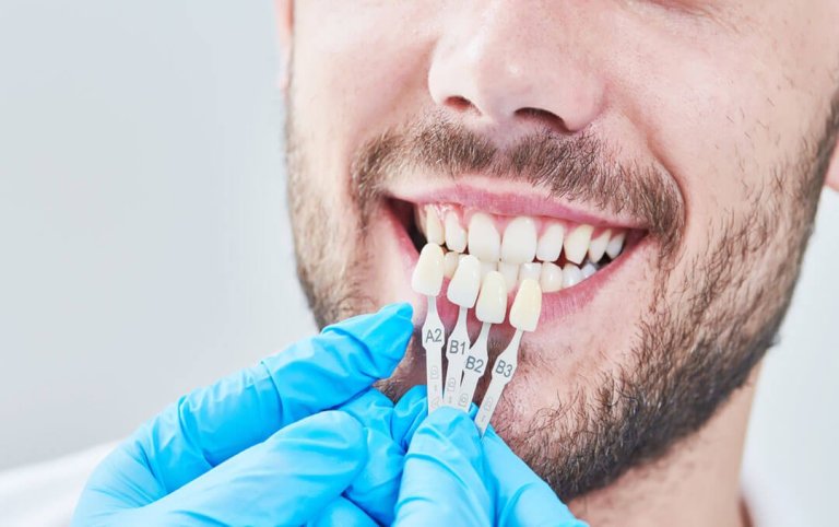 Maintaining Your Veneers: Tips for Long-Term Smile Success in Las Vegas
